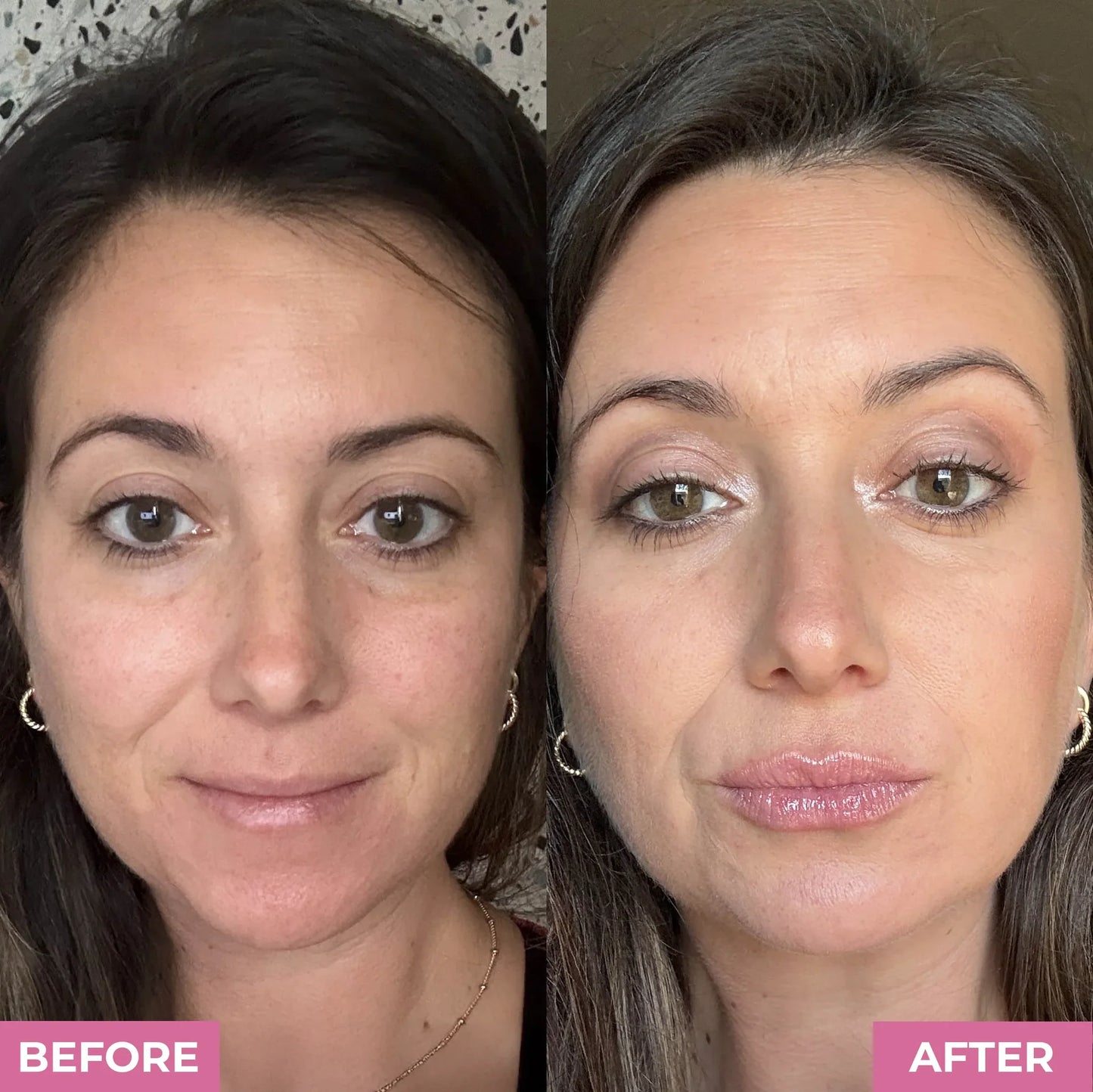 Micro-Needling Tool With Serum | Plumper Lips in Weeks
