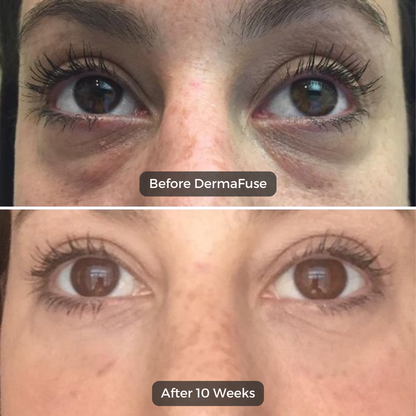 Microneedle Peptide Patches