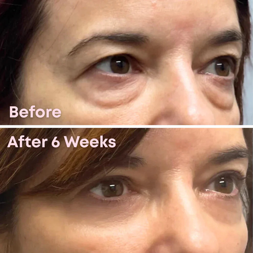 Microneedle Peptide Patches